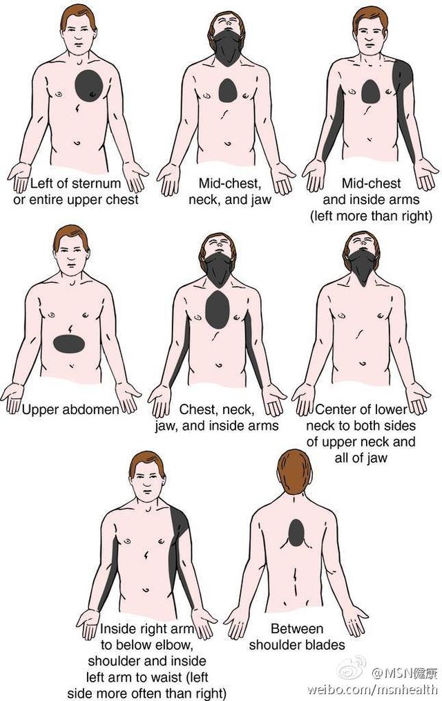 心肌梗死时可能的疼痛位置